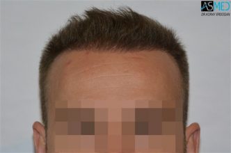 the-best-hair-transplant-surgeon-turkey (12)