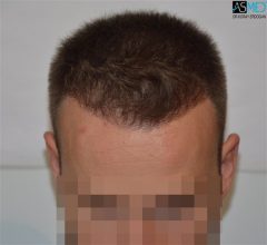 the-best-hair-transplant-surgeon-turkey (13)