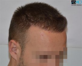 the-best-hair-transplant-surgeon-turkey (14)