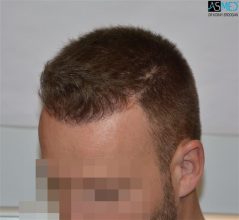 the-best-hair-transplant-surgeon-turkey (15)