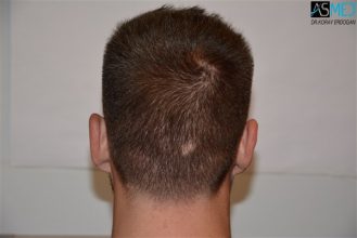 the-best-hair-transplant-surgeon-turkey (16)