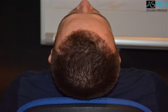 the-best-hair-transplant-surgeon-turkey (17)