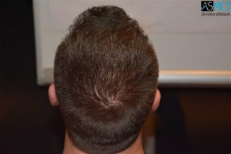 the-best-hair-transplant-surgeon-turkey (18)