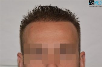 the-best-hair-transplant-surgeon-turkey (19)