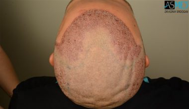 the-best-hair-transplant-surgeon-turkey (2)