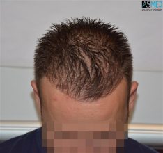 the-best-hair-transplant-surgeon-turkey (20)