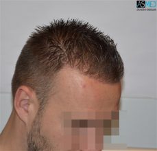the-best-hair-transplant-surgeon-turkey (21)