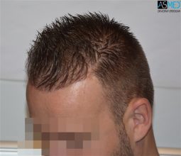 the-best-hair-transplant-surgeon-turkey (22)