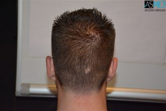 the-best-hair-transplant-surgeon-turkey (23)