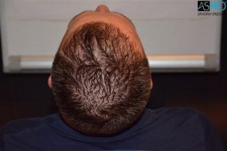 the-best-hair-transplant-surgeon-turkey (24)