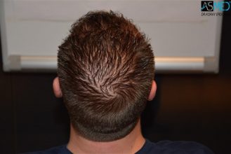 the-best-hair-transplant-surgeon-turkey (25)