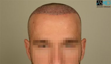 the-best-hair-transplant-surgeon-turkey (26)
