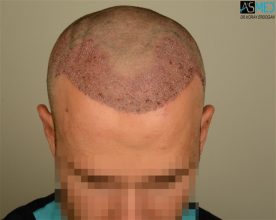 the-best-hair-transplant-surgeon-turkey (27)