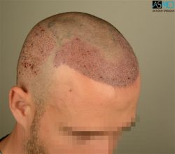 the-best-hair-transplant-surgeon-turkey (28)