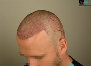 the-best-hair-transplant-surgeon-turkey (29)