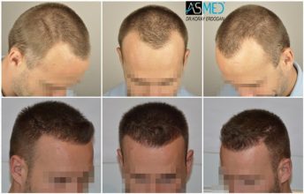 the-best-hair-transplant-surgeon-turkey (3)