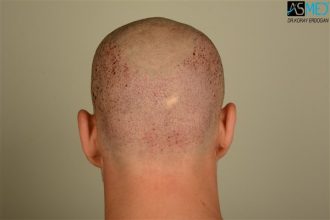 the-best-hair-transplant-surgeon-turkey (4)