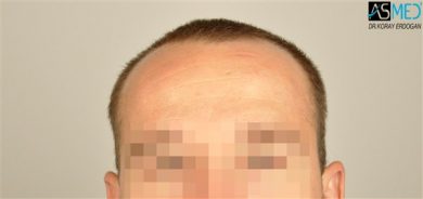 the-best-hair-transplant-surgeon-turkey (5)