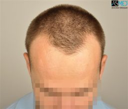 the-best-hair-transplant-surgeon-turkey (6)
