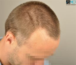 the-best-hair-transplant-surgeon-turkey (7)