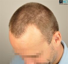 the-best-hair-transplant-surgeon-turkey (8)