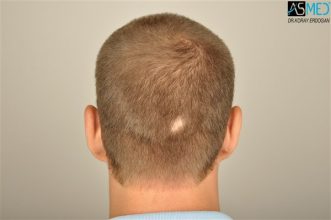 the-best-hair-transplant-surgeon-turkey (9)