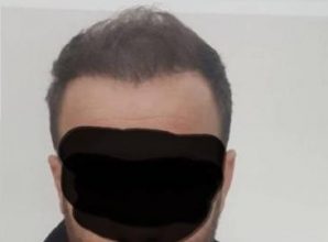 thinning hair (1)
