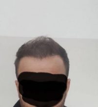 thinning hair (1)