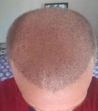 thinning hair (3)