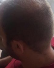 thinning hair (4)