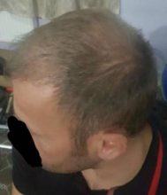 thinning hair (6)