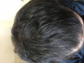 before-after-hair-transplant-turkey (1)
