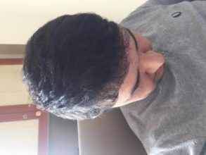 before-after-hair-transplant-turkey (10)
