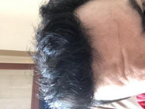 before-after-hair-transplant-turkey (14)