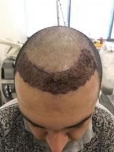 before-after-hair-transplant-turkey (16)