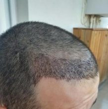 before-after-hair-transplant-turkey (18)