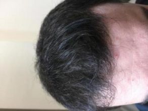 before-after-hair-transplant-turkey (2)