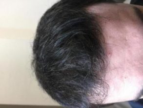 before-after-hair-transplant-turkey (23)
