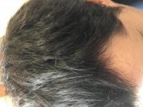 before-after-hair-transplant-turkey (3)