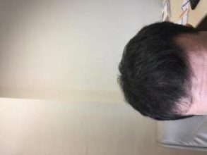 before-after-hair-transplant-turkey (4)