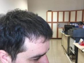 before-after-hair-transplant-turkey (6)
