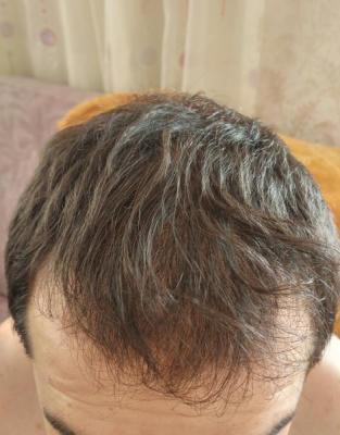 before hair transplant (3)