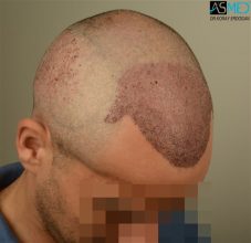 best-hair-transplant-istanbul (11)