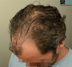 best-hair-transplant-istanbul (14)