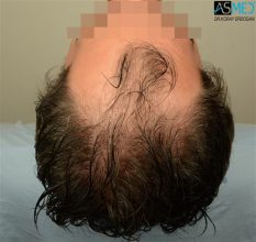 best-hair-transplant-istanbul (18)