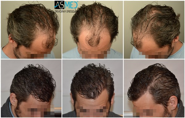 best-hair-transplant-istanbul (2)