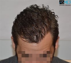 best-hair-transplant-istanbul (5)