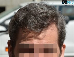 best-hair-transplant-istanbul (6)
