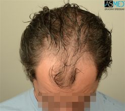 best-hair-transplant-istanbul (7)