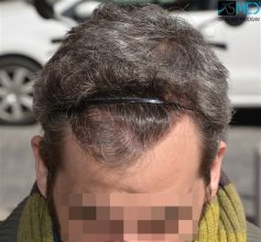 best-hair-transplant-istanbul (9)